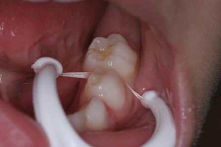 floss 1 floss 1